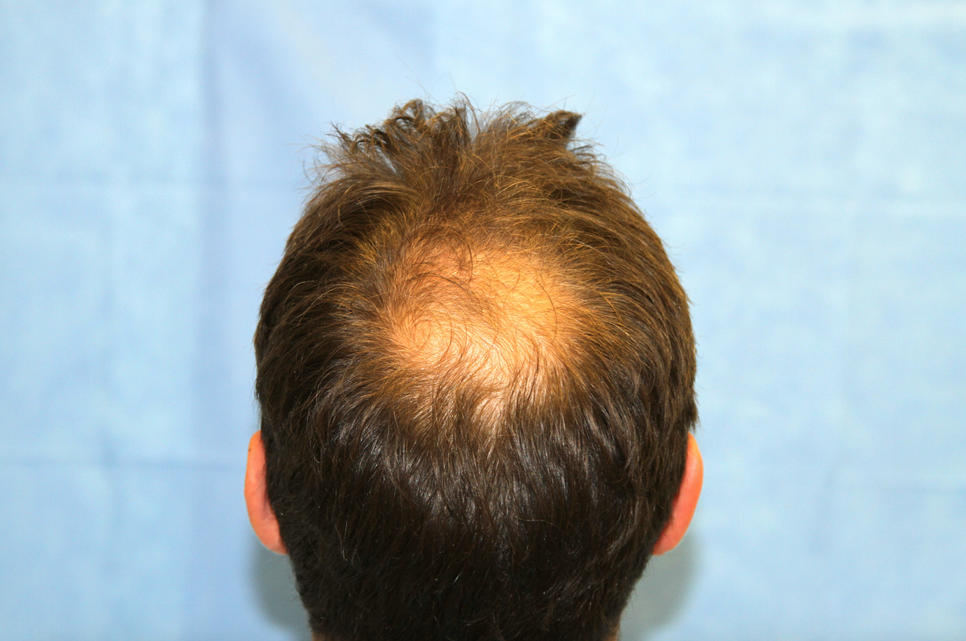 Dr Reddy (London UK) 2703 grafts Norwood 4 Hair Transplant HairSite