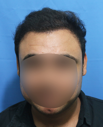 Hair%20Transplant%20Result%20-After%20picture%20-%20A216%20-%20drasclinic%20(1)