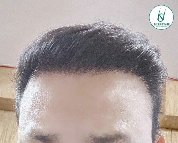 After 07 Months Hair Transplant Results (A)  from The Hairsmith Clinic