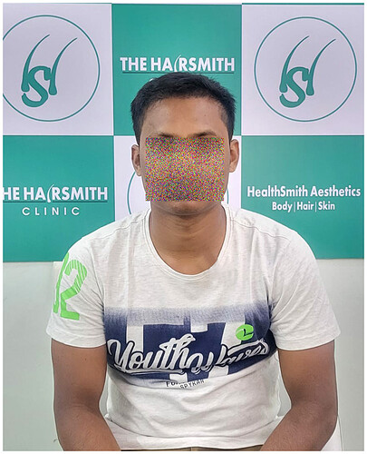 After Best Hair Transplant Result picture 2  - The Hairsmith Clinic - We Care For Your Hair
