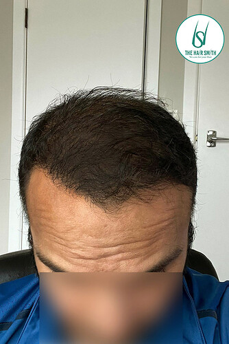 After Hair Transplant Picture (A) form The Hairsmith Clinic - We Care For Your Hair