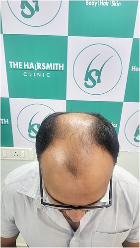 Patinet Before Hairloss Picture A~1
