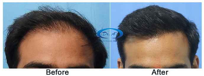 Hair%20Transplant%20Result%20-%20A215%20-%20drasclinic%20(2)