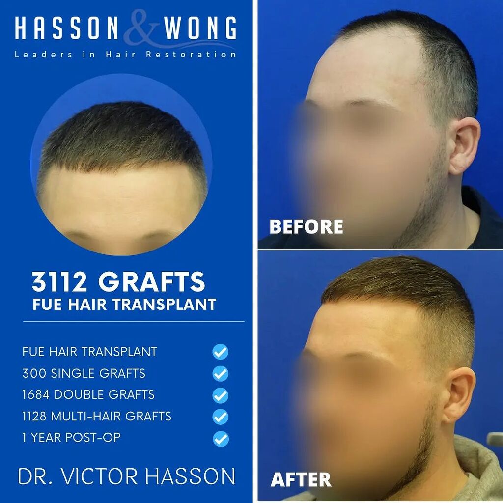 Hasson & Wong 3112 grafts FUE - Norwood 3, deep temple recession - Hair  Transplant - HairSite - Hair Restoration Forum