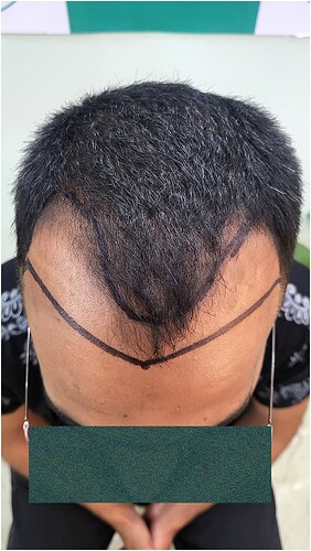 Patient Norwood stages 3 Before  Picture 3 at The Hairsmith Hair Transplant Clinic