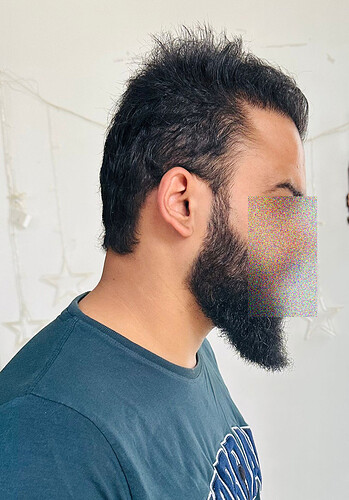 After 8 Months  Hair Transplant Result  (B) at The Hairsmith Clinic - We Care For Your Hair