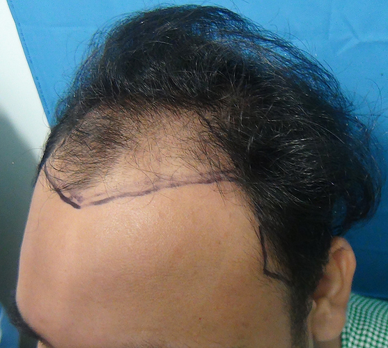 Hair%20Transplant%20Result%20-Before%20picture%20-%20A216%20-%20drasclinic%20(2)