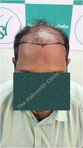 Patient Norwood stages 8 Before  Picture 1 at The Hairsmith Hair Transplant Clinic