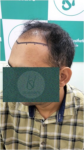 Patient Norwood stages 5 - Before  Picture 4 - The Hairsmith Hair Transplant Clinic