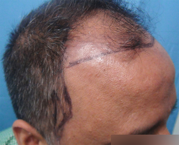 Hair%20Transplant%20Result%20-%20Before%20Picture%20-Dr%20As%20Clinic%20%20R162%20(4)