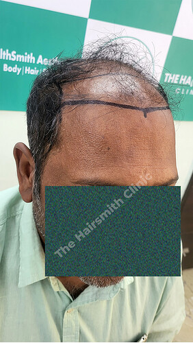Patient Norwood stages 8 Before  Picture 2 at The Hairsmith Hair Transplant Clinic