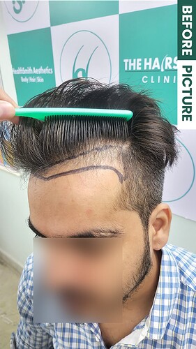 Before Picture patient from The Hairsmith Clinie - We Care For Your Hair (D)
