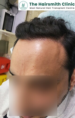 After 12 Months Hair Transplant Results (C)  from The Hairsmith Clinic