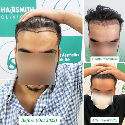 Best Hair Transplant Result  at The Hairsmith Clinic - Most Natural Hair Transplant Centre F