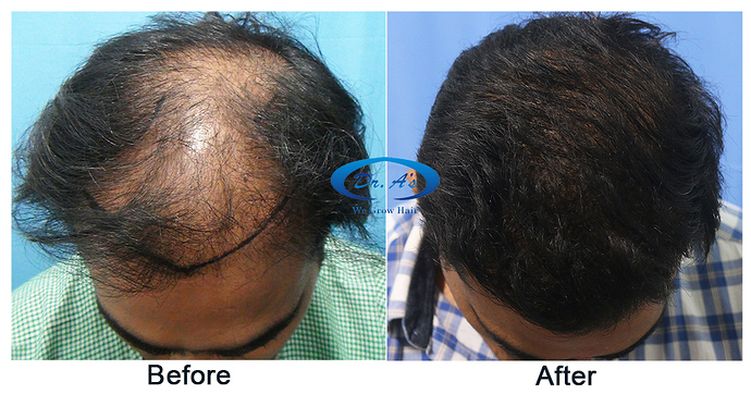 Hair%20Transplant%20Result%20-%20A215%20-%20drasclinic%20(3)