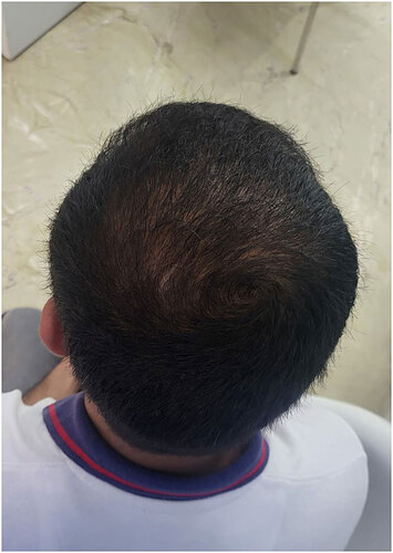 After Hair Transplant Result  Picture B from The Hairsmith Hair Transplant Clinic