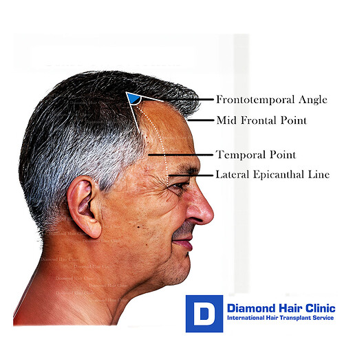 hairline design in hair transplant - important points on face and hairline