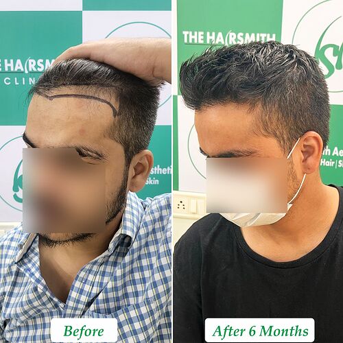 Best Hair Transplant Result  at The Hairsmith Clinic - Most Natural Hair Transplant Centre C