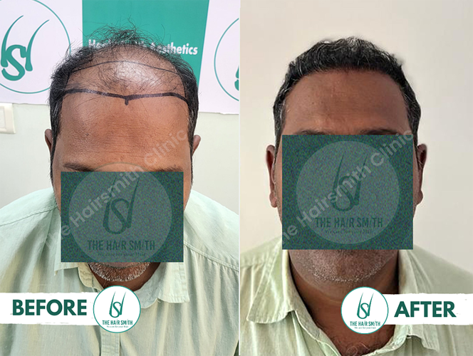 Hair Transplant Result After 06 Months  from  The Hairsmith Clinic