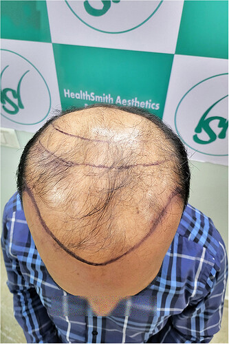 Patient Norwood stages 8 Before  Picture 4 at The Hairsmith Clinic - We Care For Your Hair
