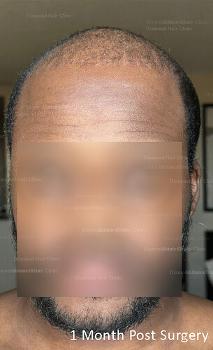 06 - Diamond Hair Clinic - Hair Transplant in Turkey - Dr. Mehmet Demircioglu - Patient Lomew - 7 (1 Month Post Surgery)