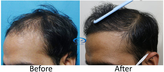 A228 - Hair Transplant Result - DrAsClinic (3)