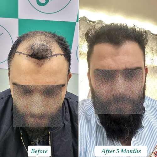 Hair Transplant Result (A) at The Hairsmith Clinic in India