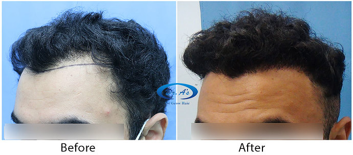 Hair-Transplant-Result(3)-DrAsClinic