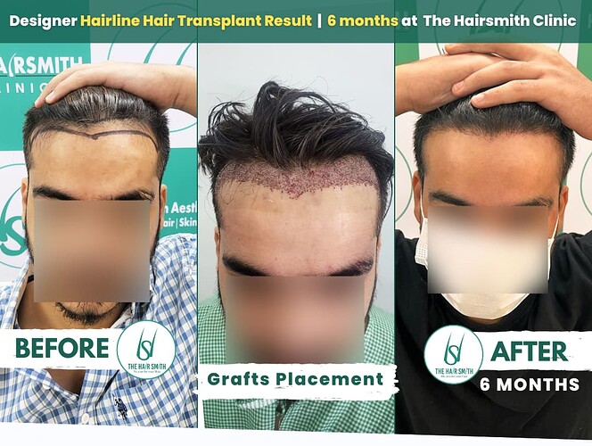 The Hairsmith Clinic - best hair transplant clinic - best hair transplant results in india - hair transplant clinic in delhi - hair transplant clinic in noida