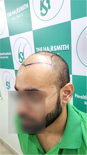 Patient Before Hair Loss Picture 4 at The Hairsmith Clinic - We Care For Your Hair