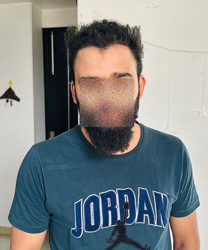 After 8 Months  Hair Transplant Result  (AA) at The Hairsmith Clinic - We Care For Your Hair