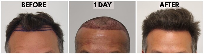 Before-Surgical-After-Hairline-New