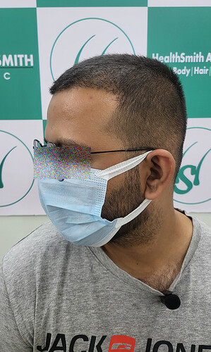 After 6 Months Hair Transplant Picture (3)  The Hairsmith Clinic - We Care For Your Hair