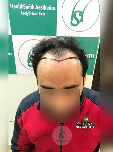 Patient Before Picture (A)  from The Hairsmith - Best Hair Transplant Centre