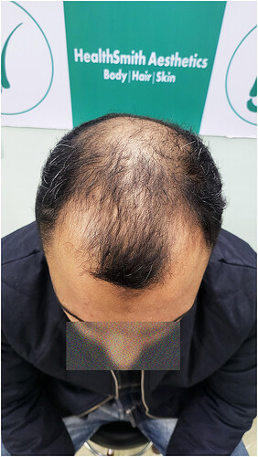 Patient Before Hair Loss Picture (C) at The Hairsmith Clinic