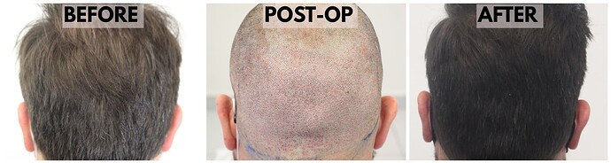 Before-Postop-After-Donor