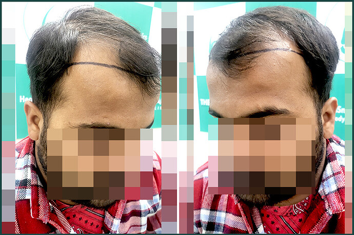 Before Hair Transplant HS 830- The Hairsmith Clinic Delhi India 2