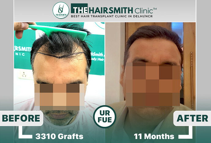 the hairsmith clinic hair transplant results before and after