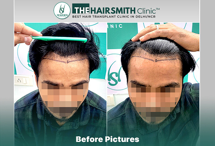 Before Hair Transplant HS 835- #hairtransplant #thehairsmithclinic #urfuehairtransplant #thehairsmithhairtransplant