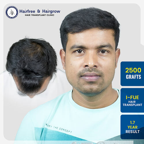 rafikkul-m-shaikh-2500-grafts-i-fue-hair-transplant-1-7-year-result-pune.jpg