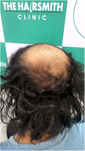 Before Hair Transplant HS 822- The Hairsmith Clinic Delhi India (4)