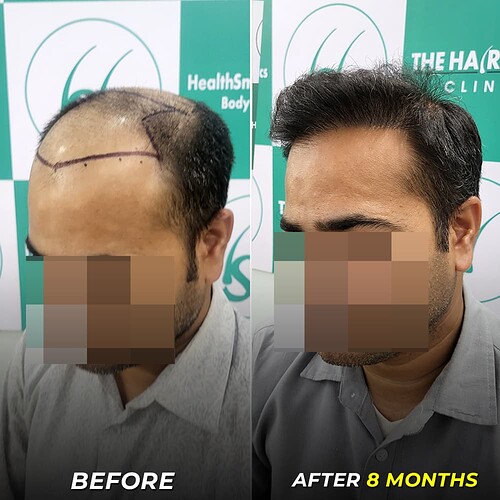 best hair transplant after 8 months at the hairsmith clinic - 3