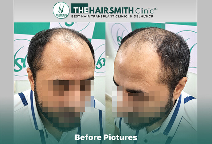 Before Hair Transplant HS 841 - The Hairsmith Clinic Delhi India #HairTransplant #URFUEHairTransplant #TheHairsmithClinic
