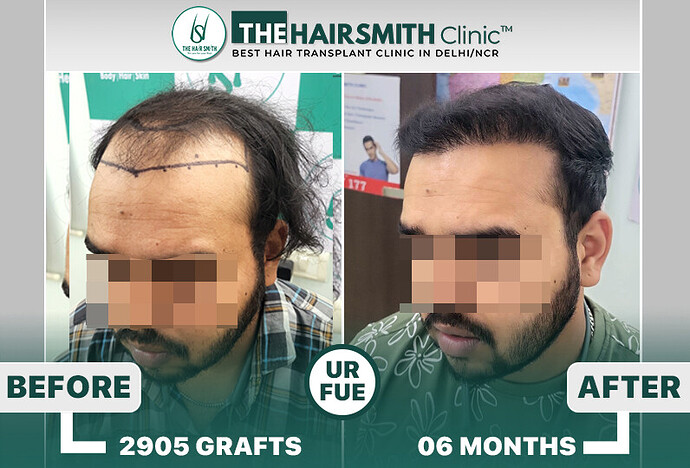 6 months hairsmith hair transplant result - The Hairsmith Clinic - #HairTransplant #The HairmsithClinic #URFUEHairTransplant #HairsmithHairTransplantResults
