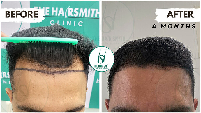 After Hair Transplant Result from The Hairsmith Clinic