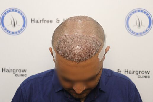 after hair transplant
