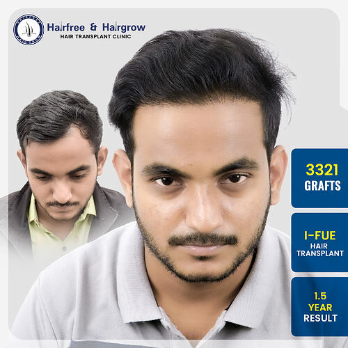sarthak-shinde-3321-grafts-hair-transplant-1-5-year-result-pune.jpg