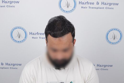 after 1 year hair transplant result