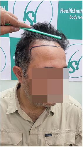 Before Hair Transplant Picture 4 - The Hairsmith Clinic