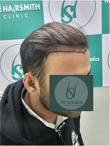 Patient Norwood stages 3 - Before  Picture (3) - The Hairsmith Hair Transplant Clinic
